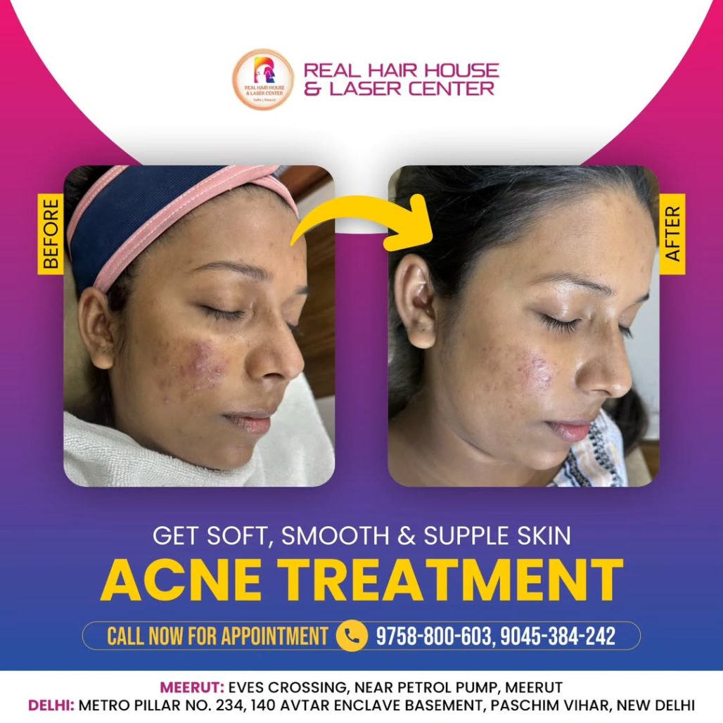 Acne Treatment- Get Ready to Glow📞 Need info Call us at 9536-384-242 or 9045-384-242! 🌟📍 Del