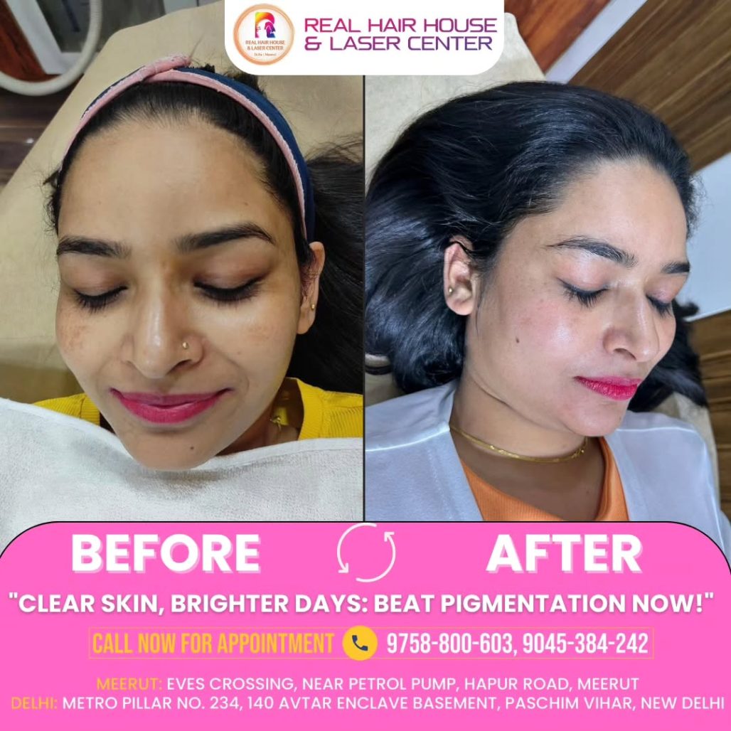 Brighter Skin- Defeat Pigmentation for a Clearer Look Now!📞 Need info Call us at 9536-384-242