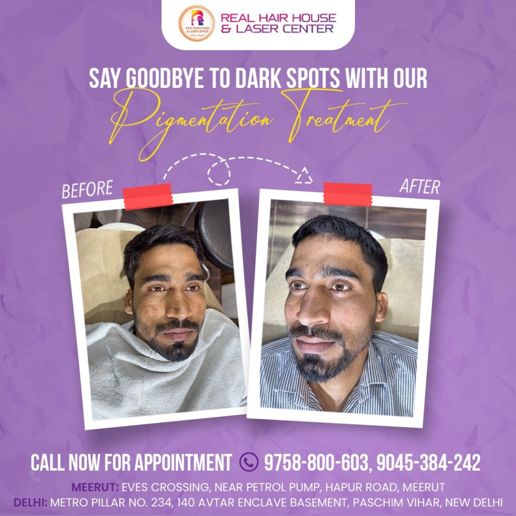 Bye-Bye Dark Spots- Try Our Pigmentation Treatment for Clearer Skin!Book now for a free consulta