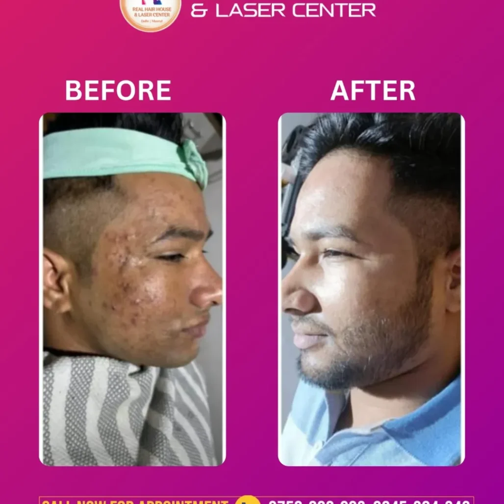 Clear skin. Renewed confidence ✨Witness real results with advanced laser skin treatment at Real