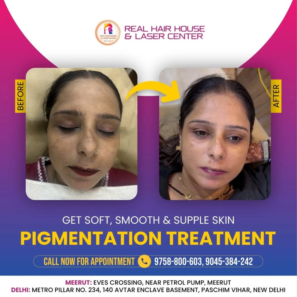 Glow like never before! ✨ Achieve smooth, spotless skin with our pigmentation treatment. Book y