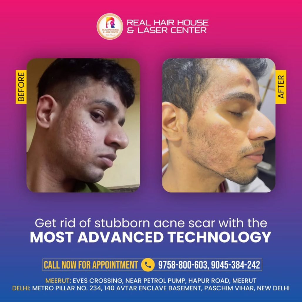 Say Goodbye to Stubborn Acne Scars!Get clear, smooth skin with the most advanced technology ava